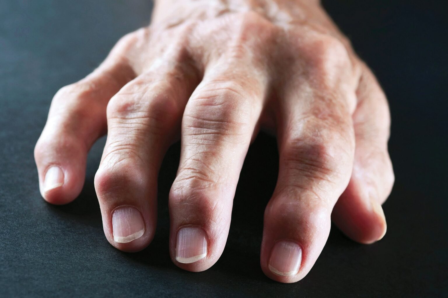 PT Health Watch: Why more young Nigerians are developing arthritis – Experts