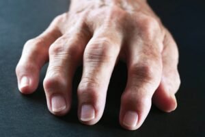 PT Health Watch: Why more young Nigerians are developing arthritis – Experts