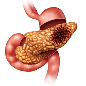The Basics Of Pancreatic Cancer