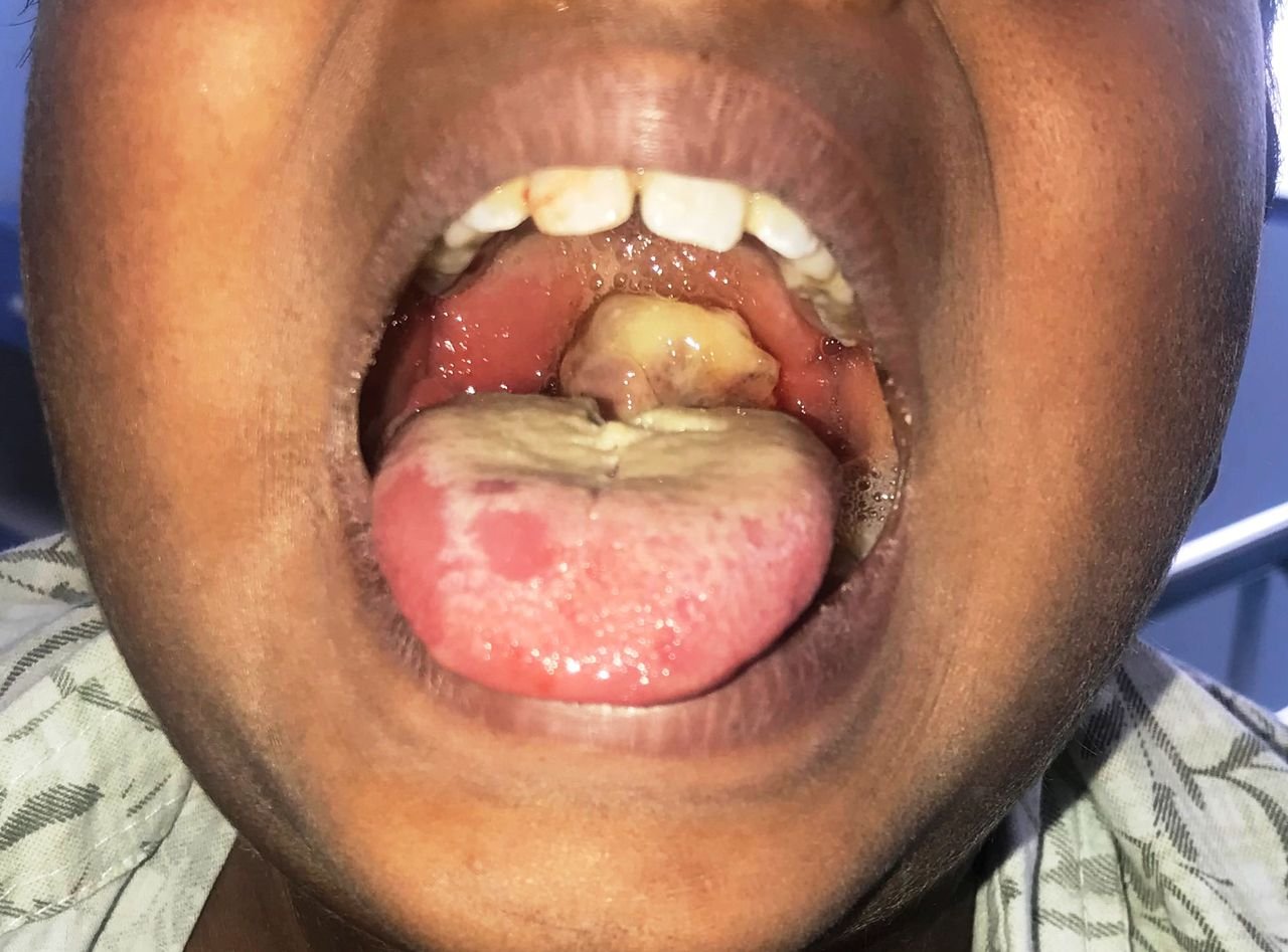 Diphtheria Patient (PHOTO CREDIT: The Guardian Nigeria)
