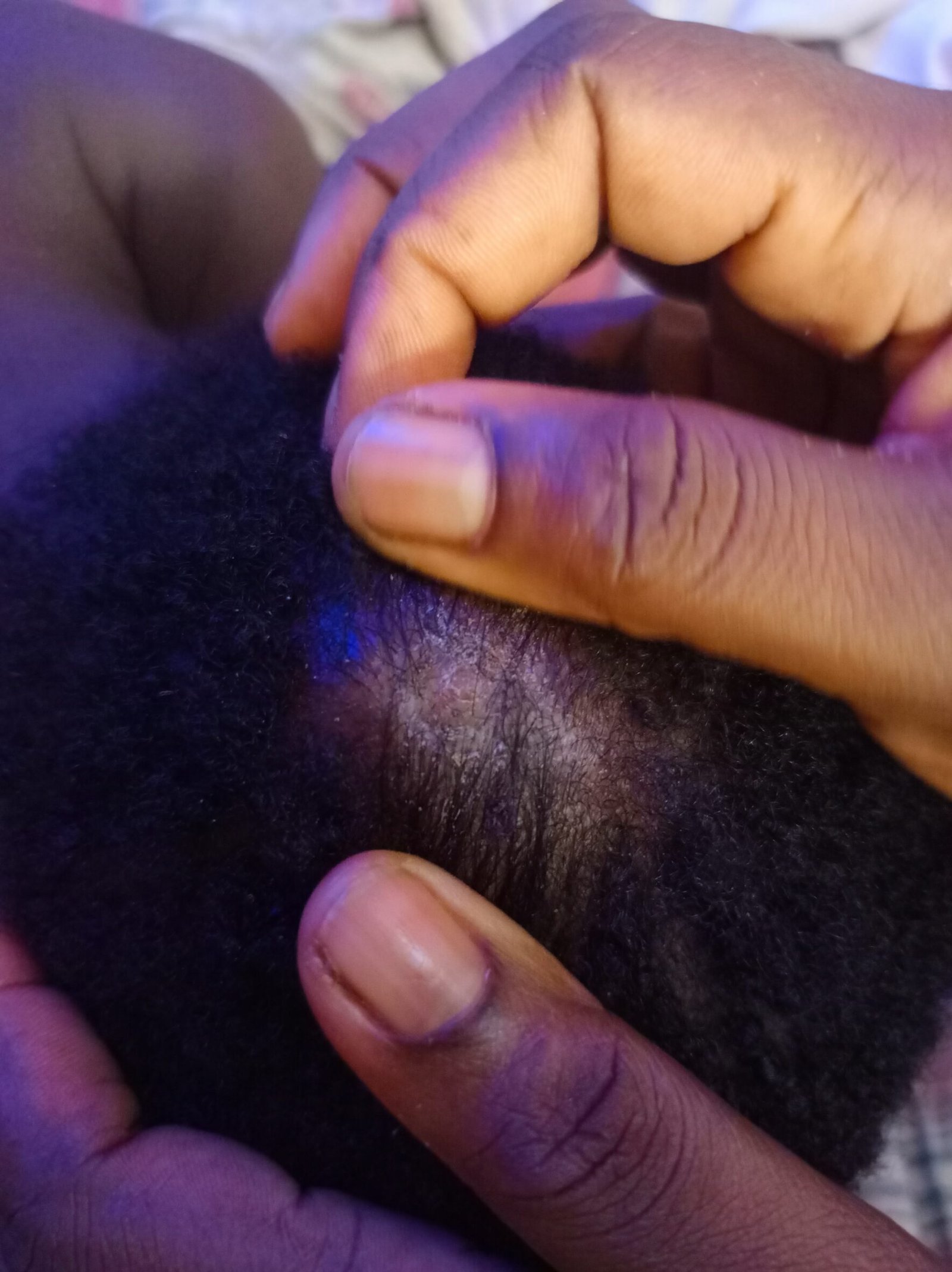 Boils on the skull of the child