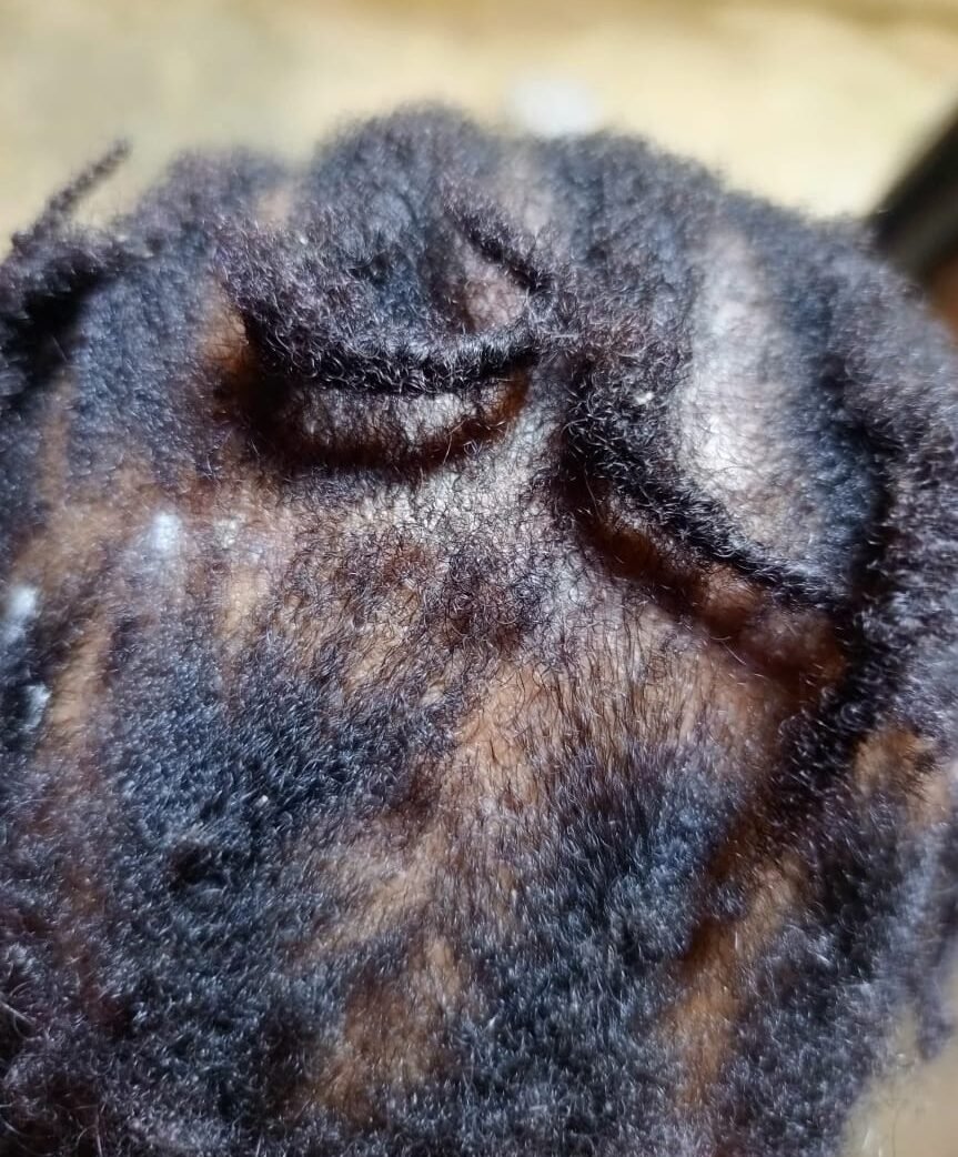 Boils on the skull of the child