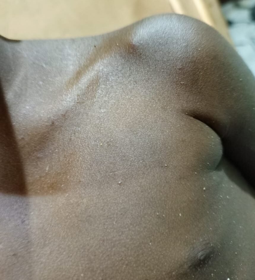 Severe skin rashes on the body of the child