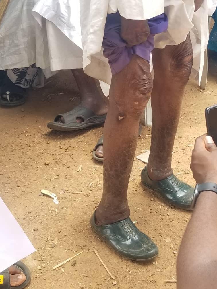 Isiah Aruna’s leg with scars from rashes