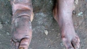 Delta govt offers free surgeries for hydrocele, lymphatic filariasis patients