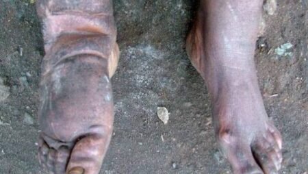 Delta govt offers free surgeries for hydrocele, lymphatic filariasis patients