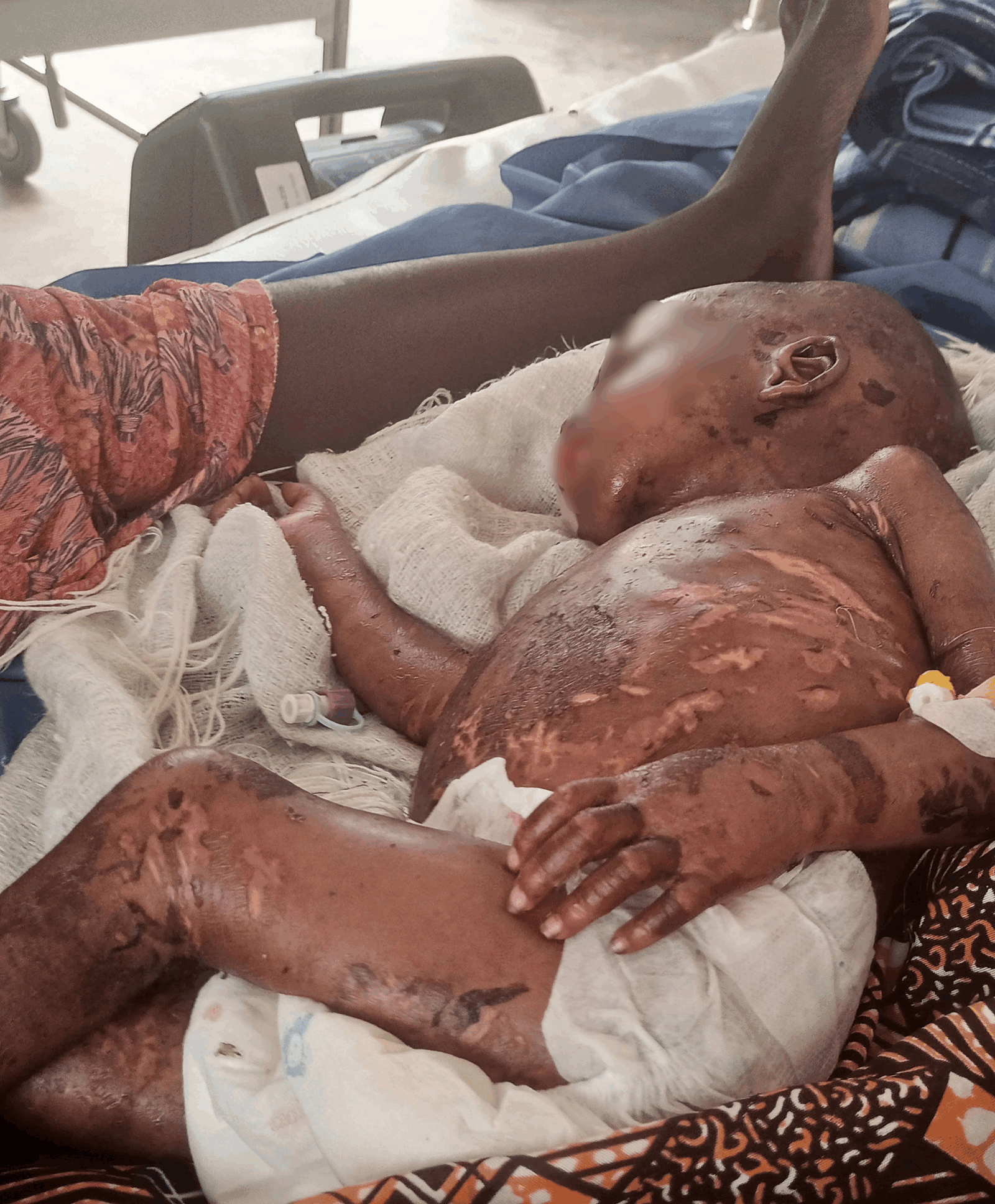 An infant suffering from severe acute malnutrition (Kwashiorkor) lies in the critical care ward. (Photo: Ogalah Dunamis)