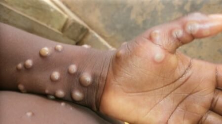 Africa seeks Mpox treatment options as cases top 61,000