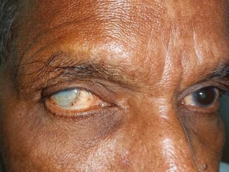 Kogi targets 4.5 million residents for river blindness prevention treatment Kogi targets 4.5 million residents for river blindness prevention treatment