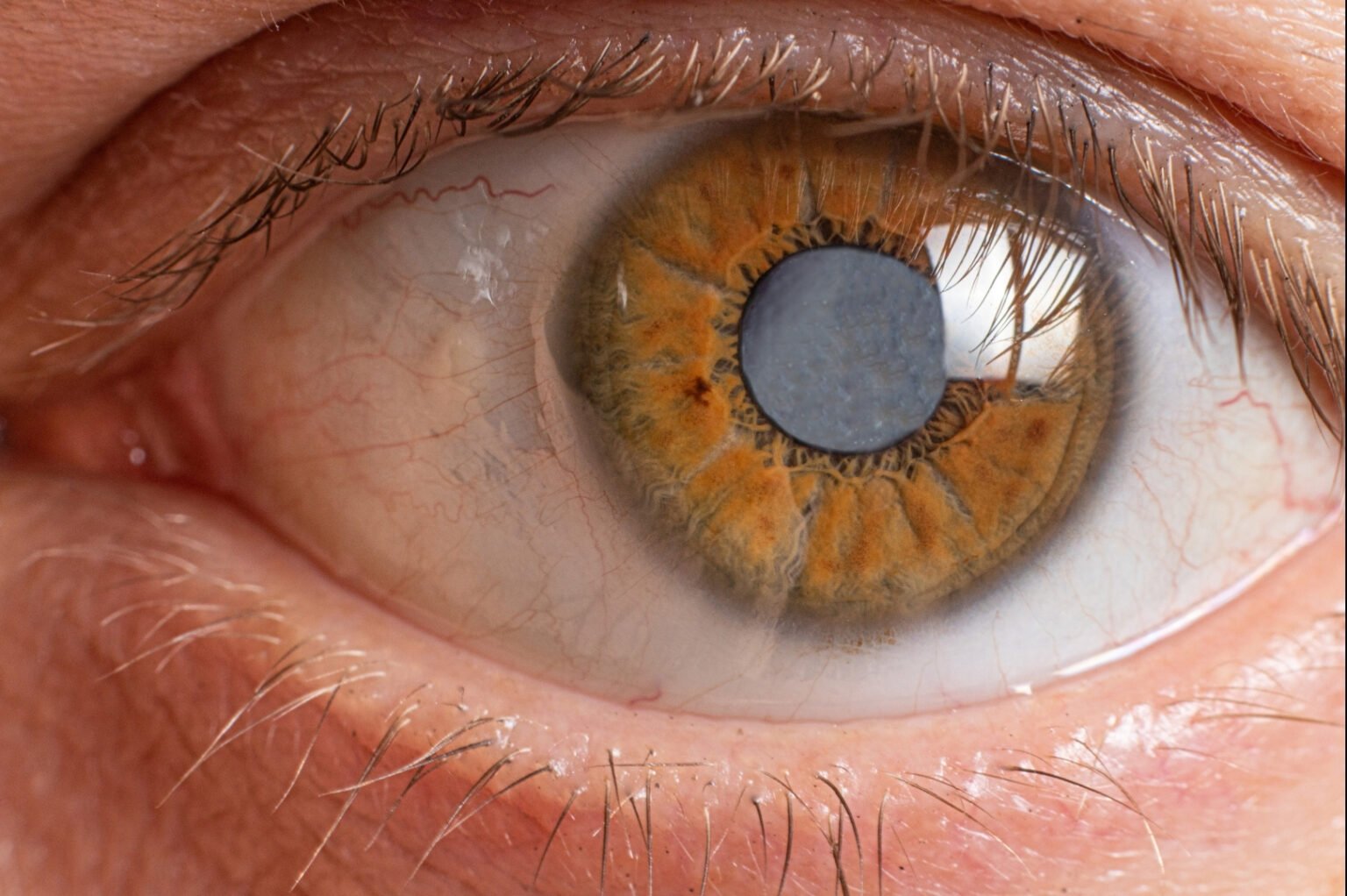 PT HEALTH WATCH: Delayed treatment of childhood cataracts can lead to irreversible vision loss – Expert PT HEALTH WATCH: Delayed treatment of childhood cataracts can lead to irreversible vision loss – Expert