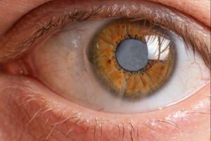 PT HEALTH WATCH: Delayed treatment of childhood cataracts can lead to irreversible vision loss – Expert